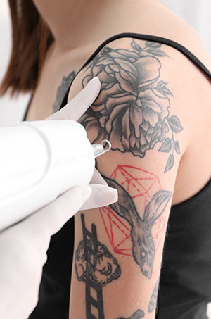 Laser Tattoo Removal Specialist Near Me in Canton, MI