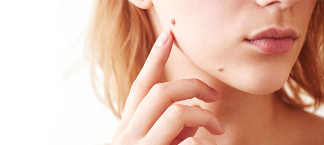 Laser Mole Removal Treatment Specialist Near Me in Canton, MI 