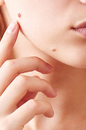 Mole Removal Treatment Near Me in Canton, MI