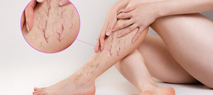 Spider Veins Treatment Specialist Near Me in Canton, MI 