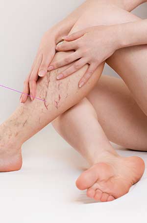 Spider Veins Treatment Near Me in Canton, MI