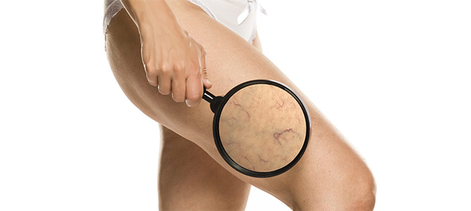 Laser Varicose Veins Treatment Specialist Near Me in Canton, MI 