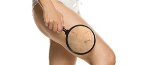 Laser Varicose Veins Treatment Specialist Near Me in Canton, MI 