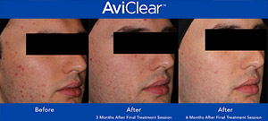 AviClear Detailed Information by Prime Skin & Laser Near Me in Canton MI