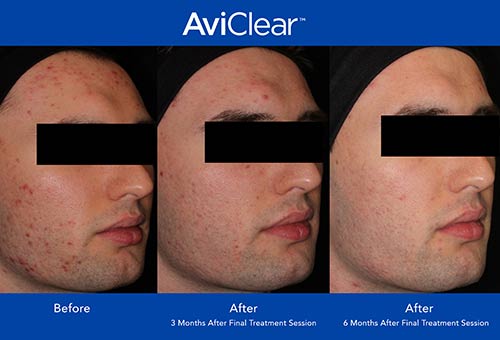 AviClear Before & After by Prime Skin & Laser in Canton MI