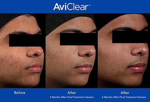 AviClear Before & After by Prime Skin & Laser in Canton MI