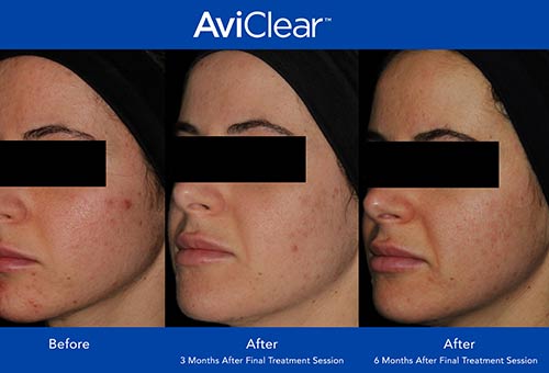 AviClear Before & After by Prime Skin & Laser in Canton MI