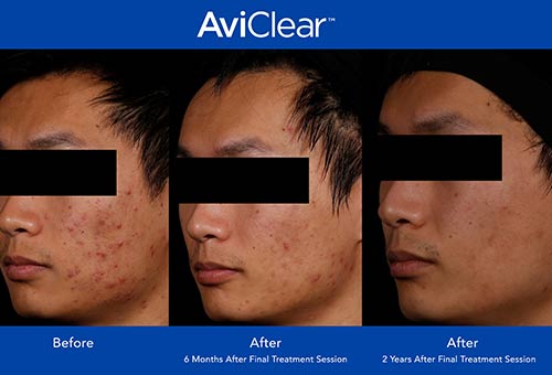 AviClear Before & After by Prime Skin & Laser in Canton MI