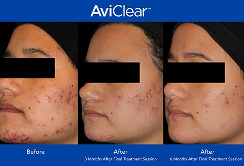 AviClear Before & After by Prime Skin & Laser in Canton MI