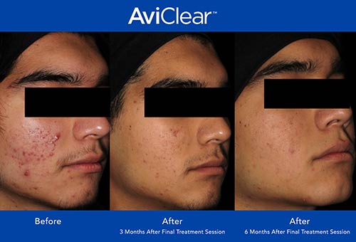 AviClear Before & After by Prime Skin & Laser in Canton MI