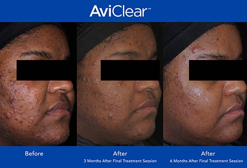 AviClear Before & After by Prime Skin & Laser in Canton MI