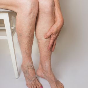 Laser Leg Veins Treatment Near Me in Canton, MI