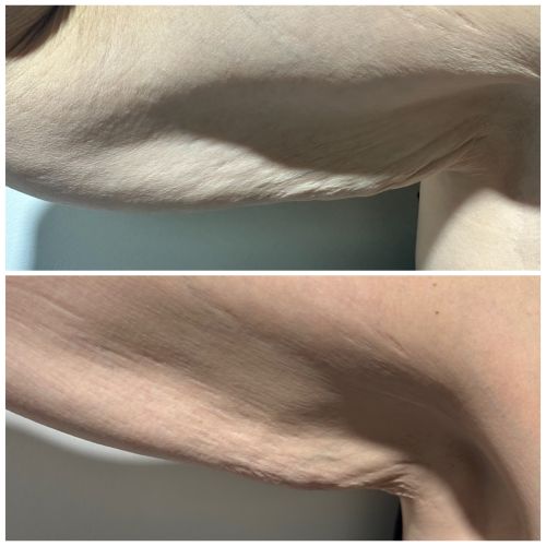 Before and After Gallery at Prime Skin & Laser Med Spa in Canton, MI