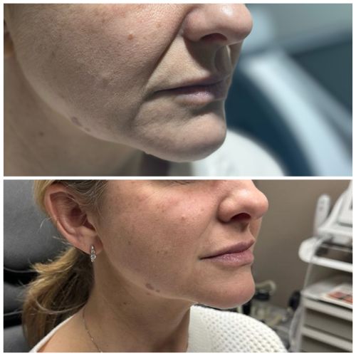 Before and After Gallery at Prime Skin & Laser Med Spa in Canton, MI