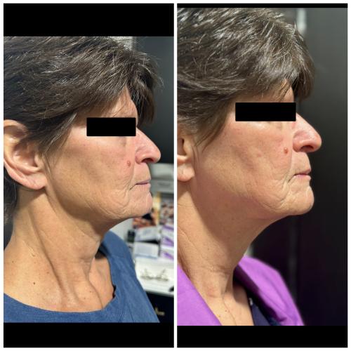 Before and After Gallery at Prime Skin & Laser Med Spa in Canton, MI