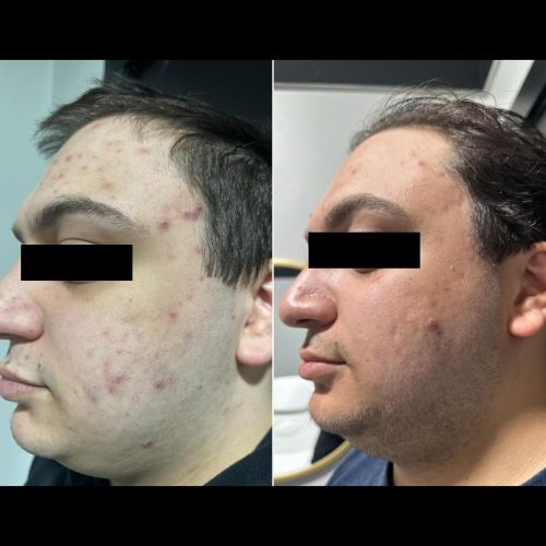Before and After Gallery at Prime Skin & Laser Med Spa in Canton, MI Before and After Gallery at Prime Skin & Laser Med Spa in Canton, MI