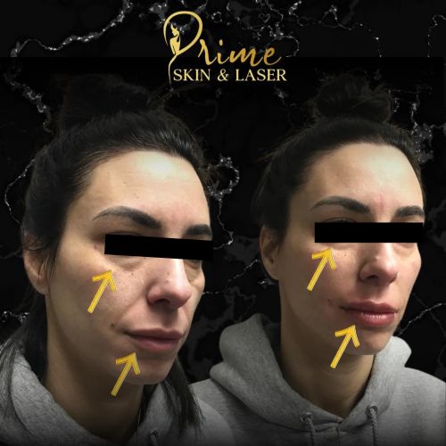 Before and After Gallery at Prime Skin & Laser Med Spa in Canton, MI Before and After Gallery at Prime Skin & Laser Med Spa in Canton, MI
