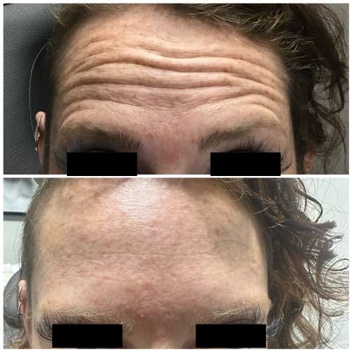 Before and After Gallery at Prime Skin & Laser Med Spa in Canton, MI Before and After Gallery at Prime Skin & Laser Med Spa in Canton, MI