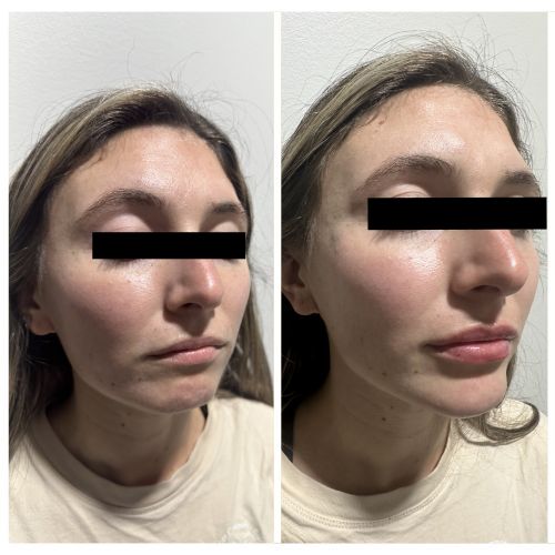 Before and After Gallery at Prime Skin & Laser Med Spa in Canton, MI Before and After Gallery at Prime Skin & Laser Med Spa in Canton, MI