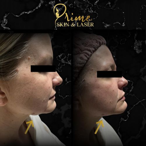 Before and After Gallery at Prime Skin & Laser Med Spa in Canton, MI Before and After Gallery at Prime Skin & Laser Med Spa in Canton, MI