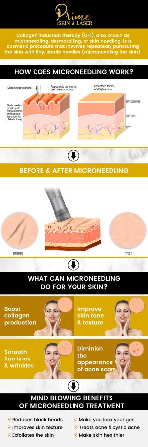 Microneedling is an effective, minimally invasive treatment designed to rejuvenate and refresh your skin by stimulating collagen production. At Prime Skin & Laser, our professional team specializes in microneedling treatments to help improve skin texture, reduce fine lines, and address acne scars. We provide customized care to ensure optimal results, all while maintaining the highest standards of safety and comfort. Contact us today for more information or schedule an appointment online. We are conveniently located at 5748 N Canton Center Rd, Canton Township, MI 48187.