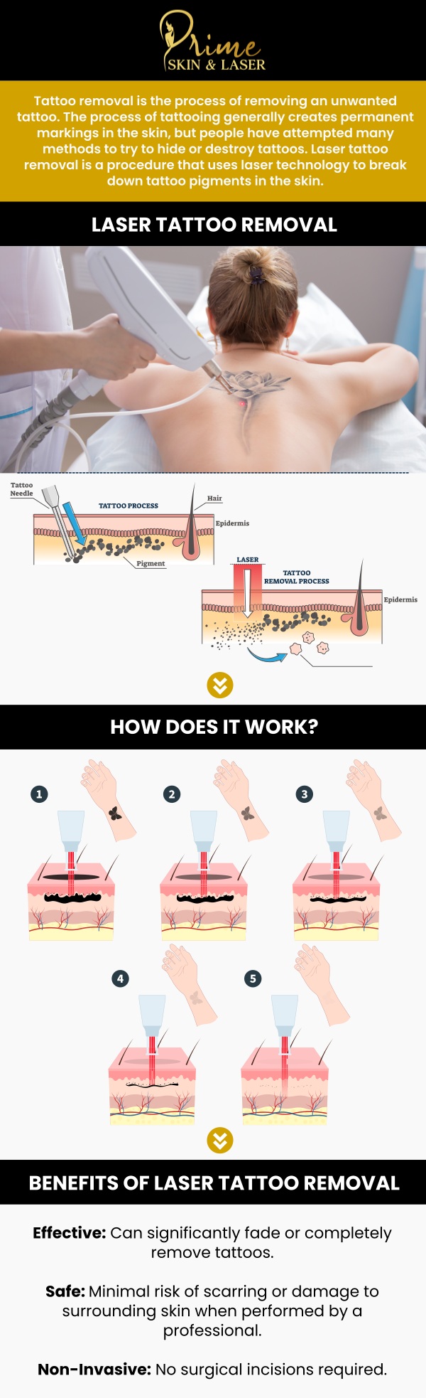 Tattoo removal starts with a personalized consultation to evaluate your skin and tattoo details for safe treatment planning. At Prime Skin and Laser, our professionals recommend arriving at your tattoo removal consultation with the area clean, free of lotions, and not recently tanned or sunburned. It also helps to share details like how long you’ve had the tattoo, any prior removal attempts, and your skin sensitivity history so we can review expectations and build a safe, customized plan. Contact us today for more information or schedule an appointment online! We are conveniently located at 5748 N Canton Center Rd, Canton Township, MI 48187.