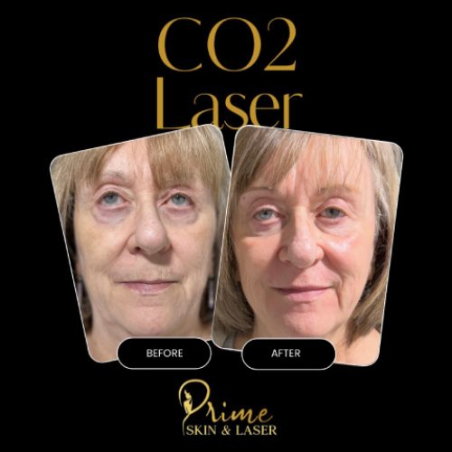 Before and After Gallery at Prime Skin & Laser Med Spa in Canton, MI