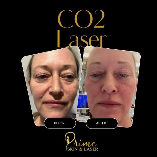 Before and After Gallery at Prime Skin & Laser Med Spa in Canton, MI Before and After Gallery at Prime Skin & Laser Med Spa in Canton, MI