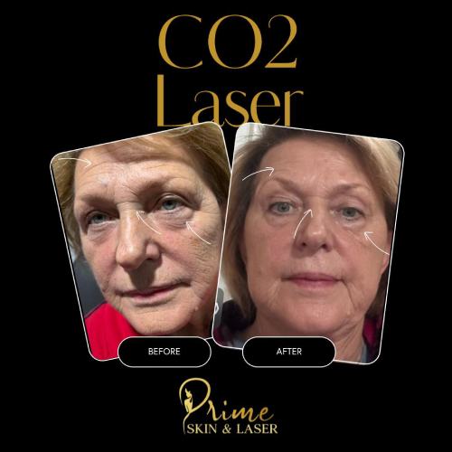 Before and After Gallery at Prime Skin & Laser Med Spa in Canton, MI Before and After Gallery at Prime Skin & Laser Med Spa in Canton, MI