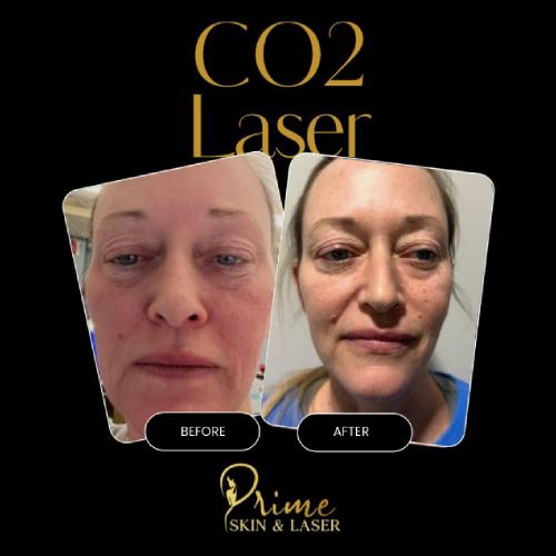 Morpheus8 Treatment Results