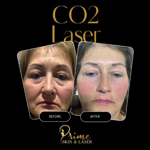 Before and After Gallery at Prime Skin & Laser Med Spa in Canton, MI Before and After Gallery at Prime Skin & Laser Med Spa in Canton, MI