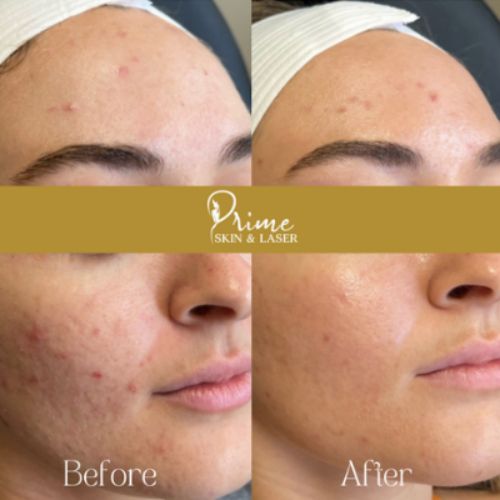 Before and After Gallery at Prime Skin & Laser Med Spa in Canton, MI