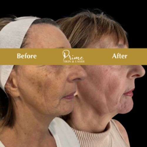 Before and After Gallery at Prime Skin & Laser Med Spa in Canton, MI