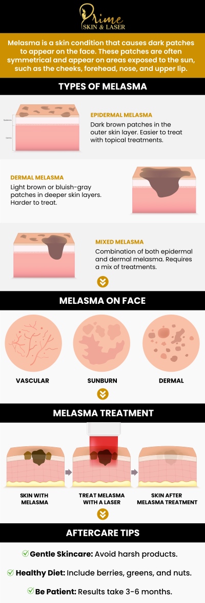 Melasma Treatment in Canton, MI